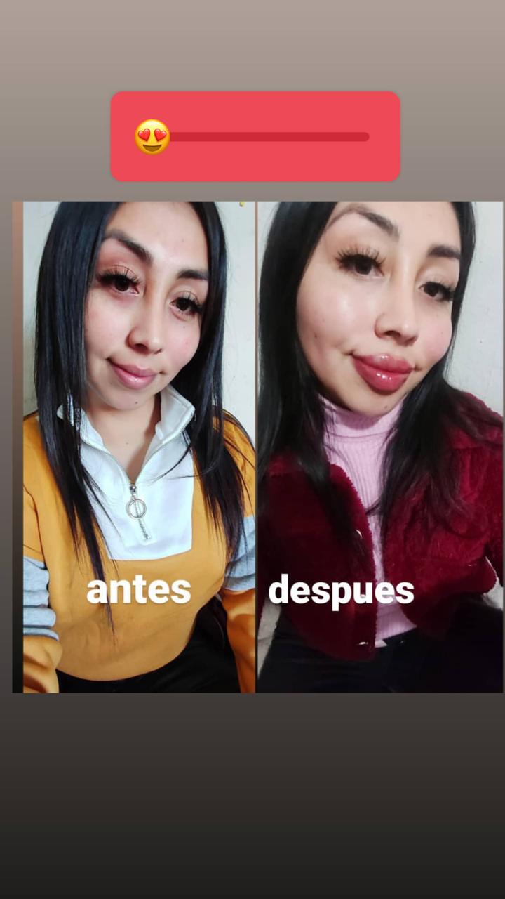 Naya Fácil mostró su increíble antes y después tras retoque facial