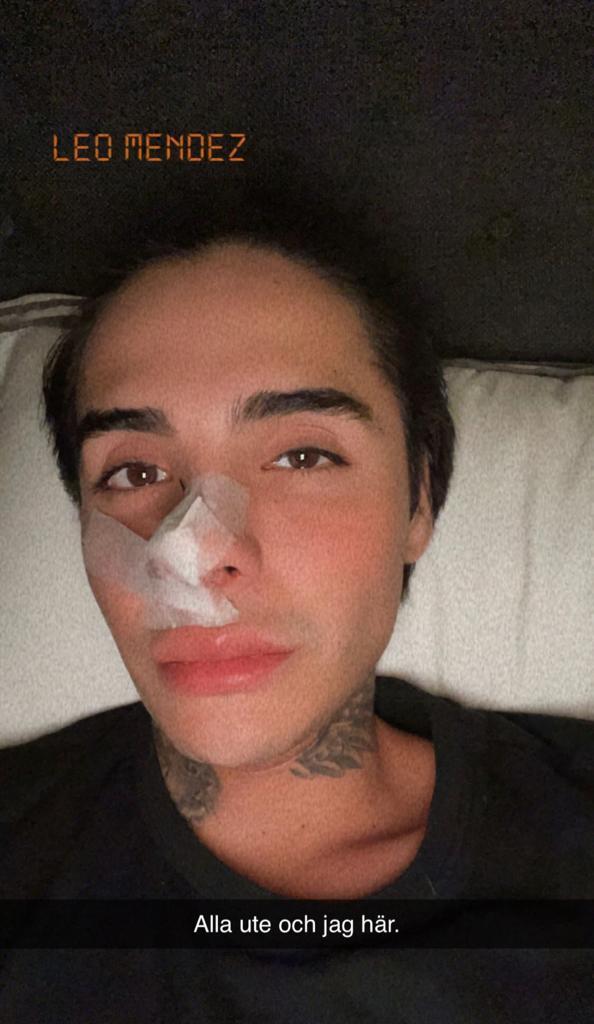 Leo Méndez Jr. se operó la nariz luego de sufrir golpiza