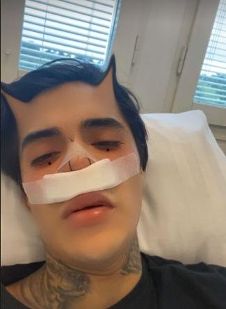 Leo Méndez Jr. se operó la nariz luego de sufrir golpiza