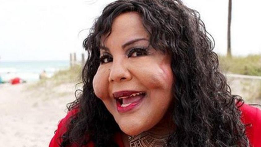 Transgénero cambió su cara y cuerpo inyectándose cemento