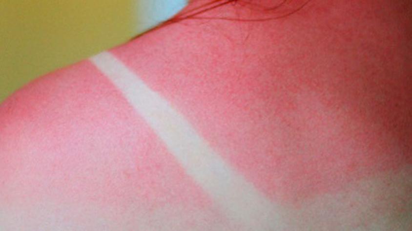 10 consejos para cuidar tu piel del sol en vacaciones 