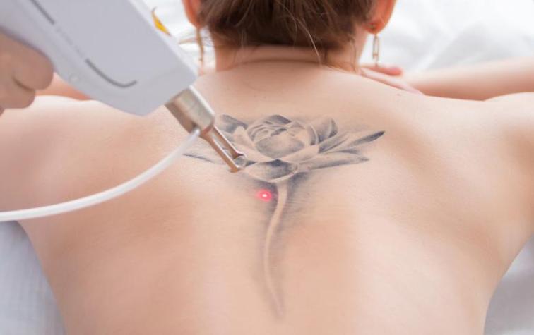 6 cosas que debes saber si te quieres borrar un tatuaje