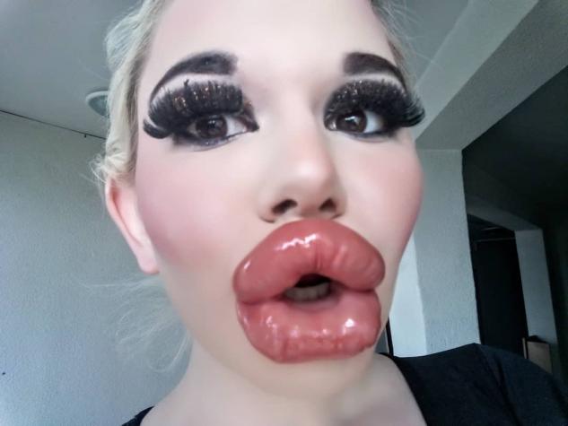 El impactante cambio de la Barbie humana que se obsesionó con sus labios